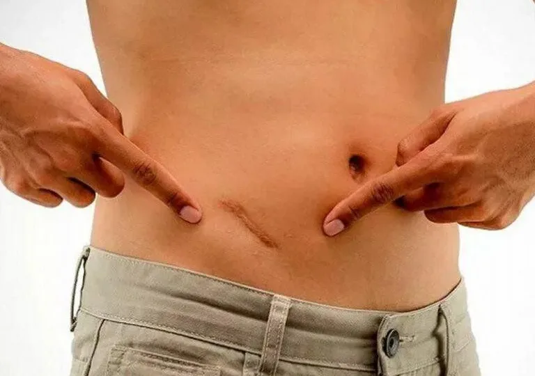 Когда каждая минута важна: как правильно вызвать скорую помощь при подозрении на аппендицит